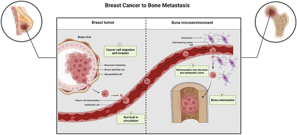 Usual Places of Metastasis