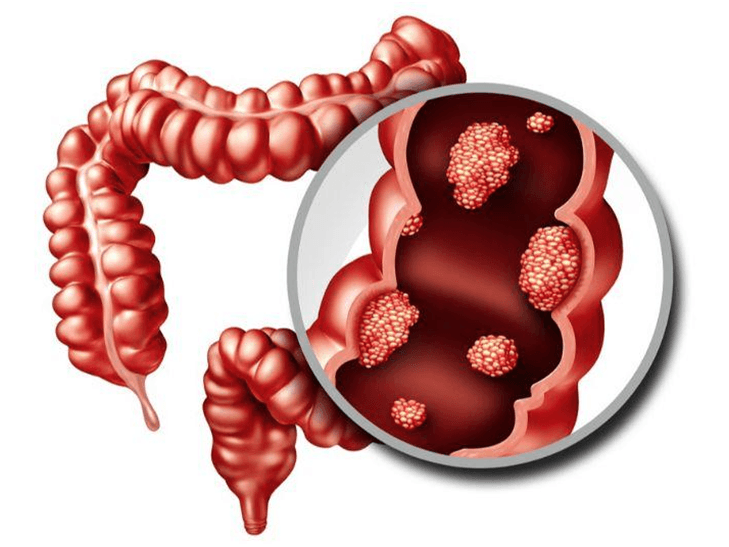 Cancer of the Colon and Rectum